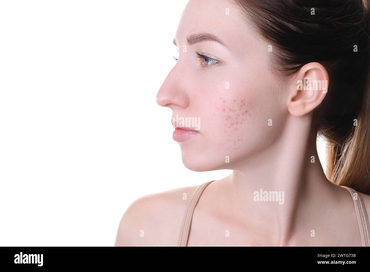 Young woman with acne problem on white background Stock Photo