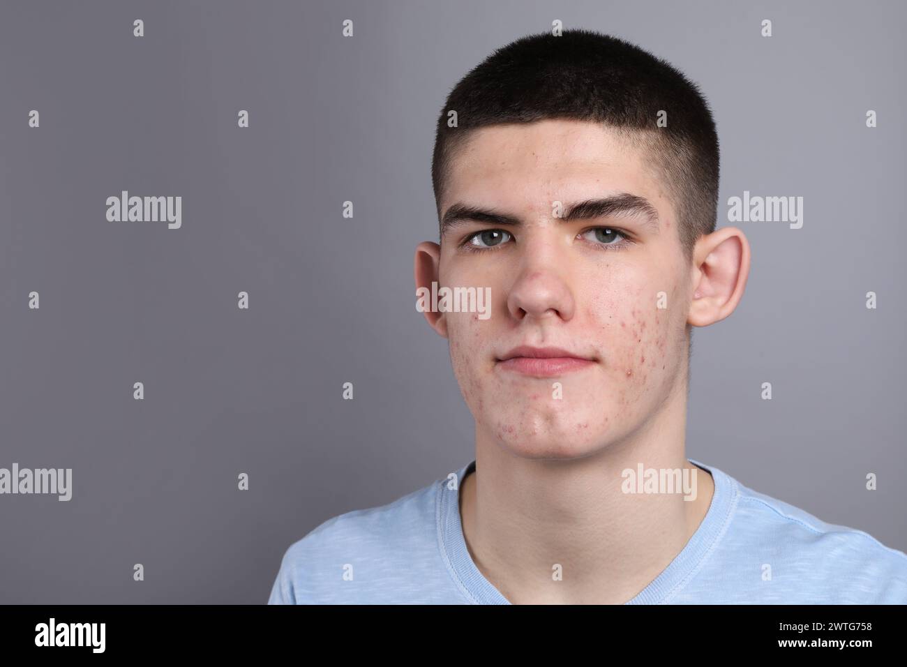 Young man with acne problem on grey background. Space for text Stock Photo