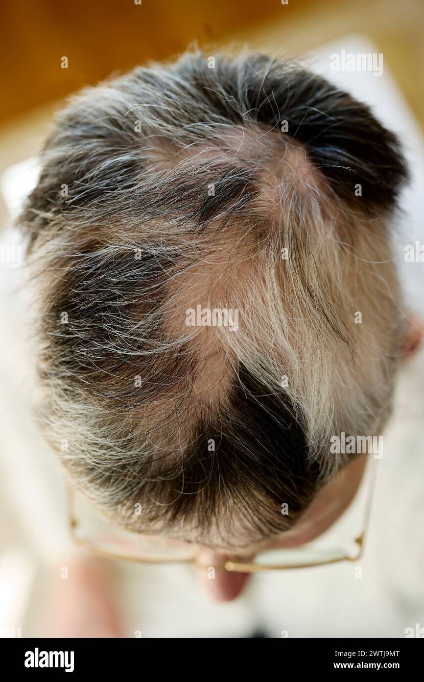 Woman with Alopecia Stock Photo