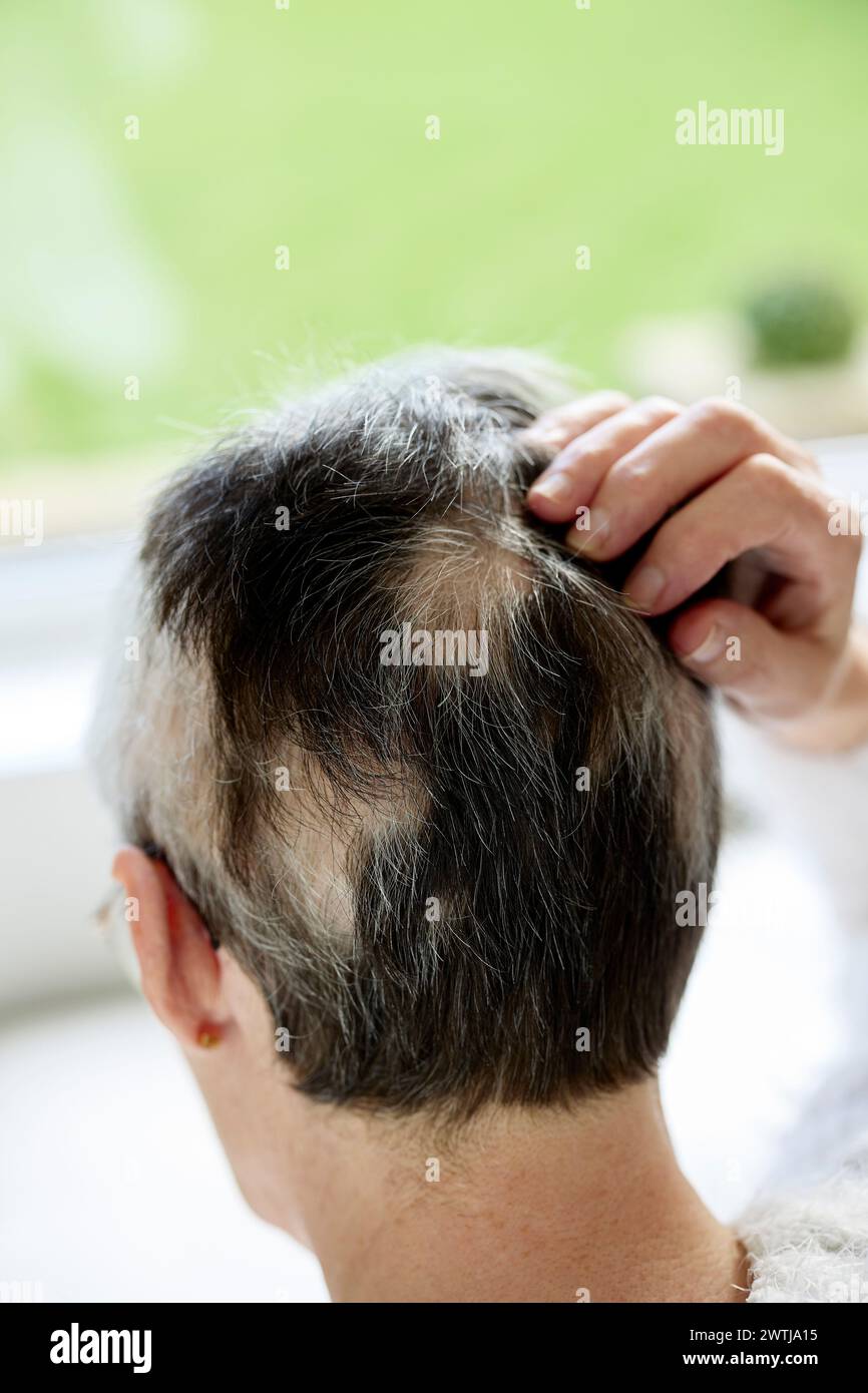 Woman with Alopecia Stock Photo
