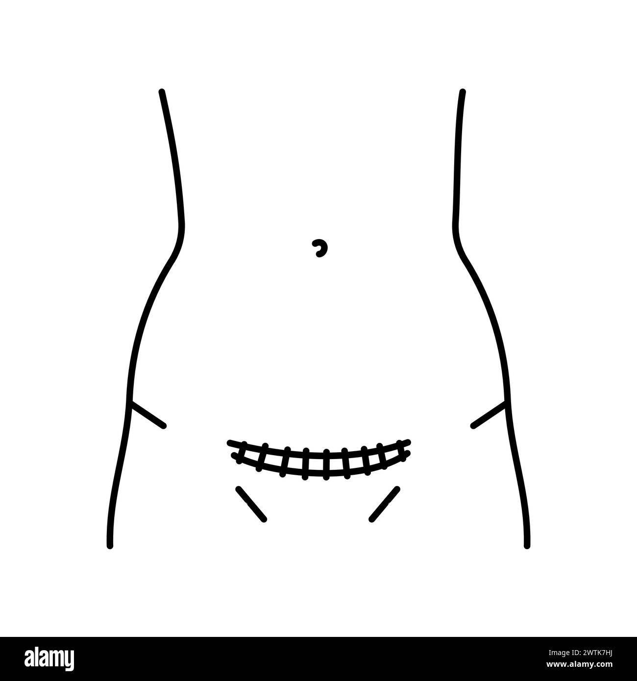 Pfannenstiel incision line icon. Abdominal incisions. Vector isolated