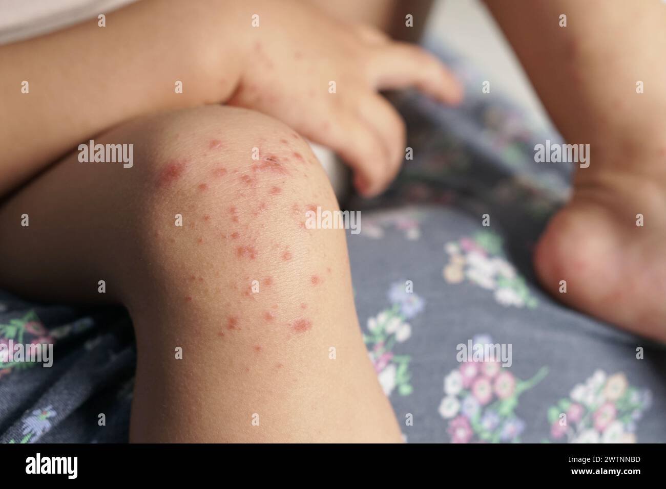 Close up view of Child's knee infected with hand feet and mouth disease