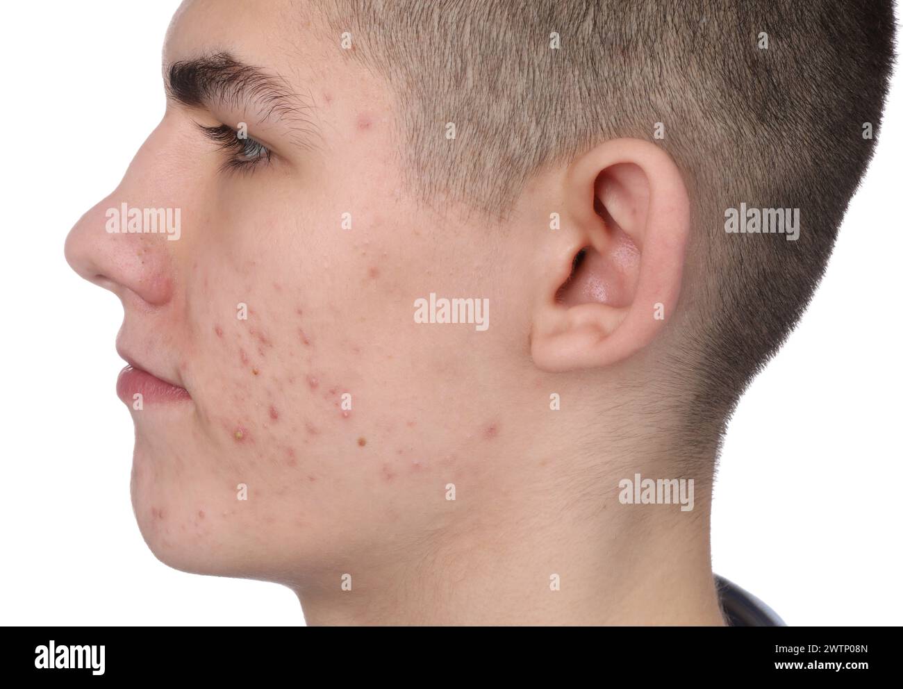 Young man with acne problem isolated on white Stock Photo