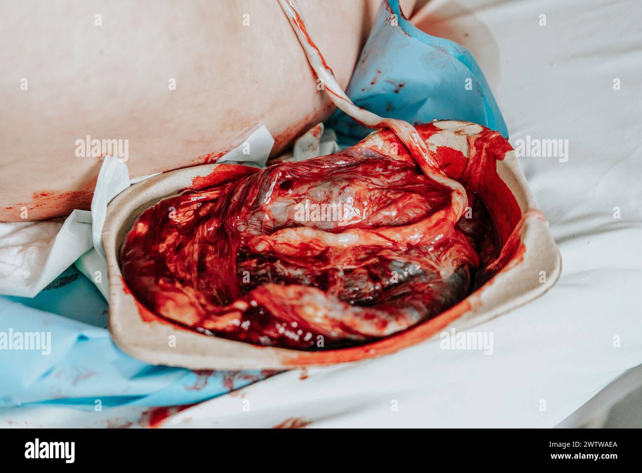 Human placenta moments after giving birth. Placenta still connected to the newborn baby, Stock Photo