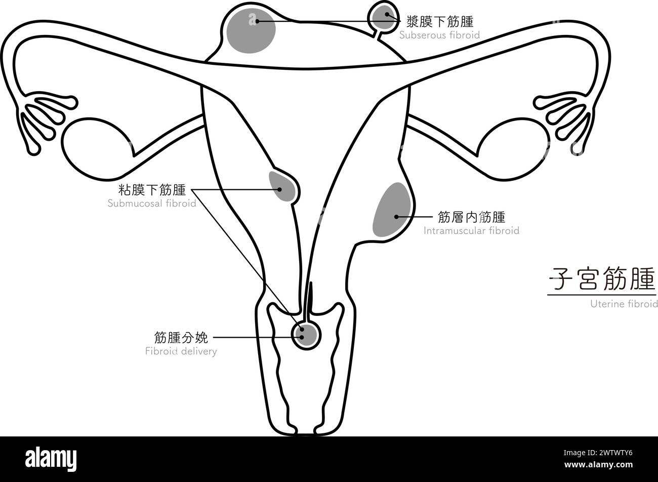 Diagrammatic Illustration Of Uterine Fibroids Anatomy Of The Uterus 