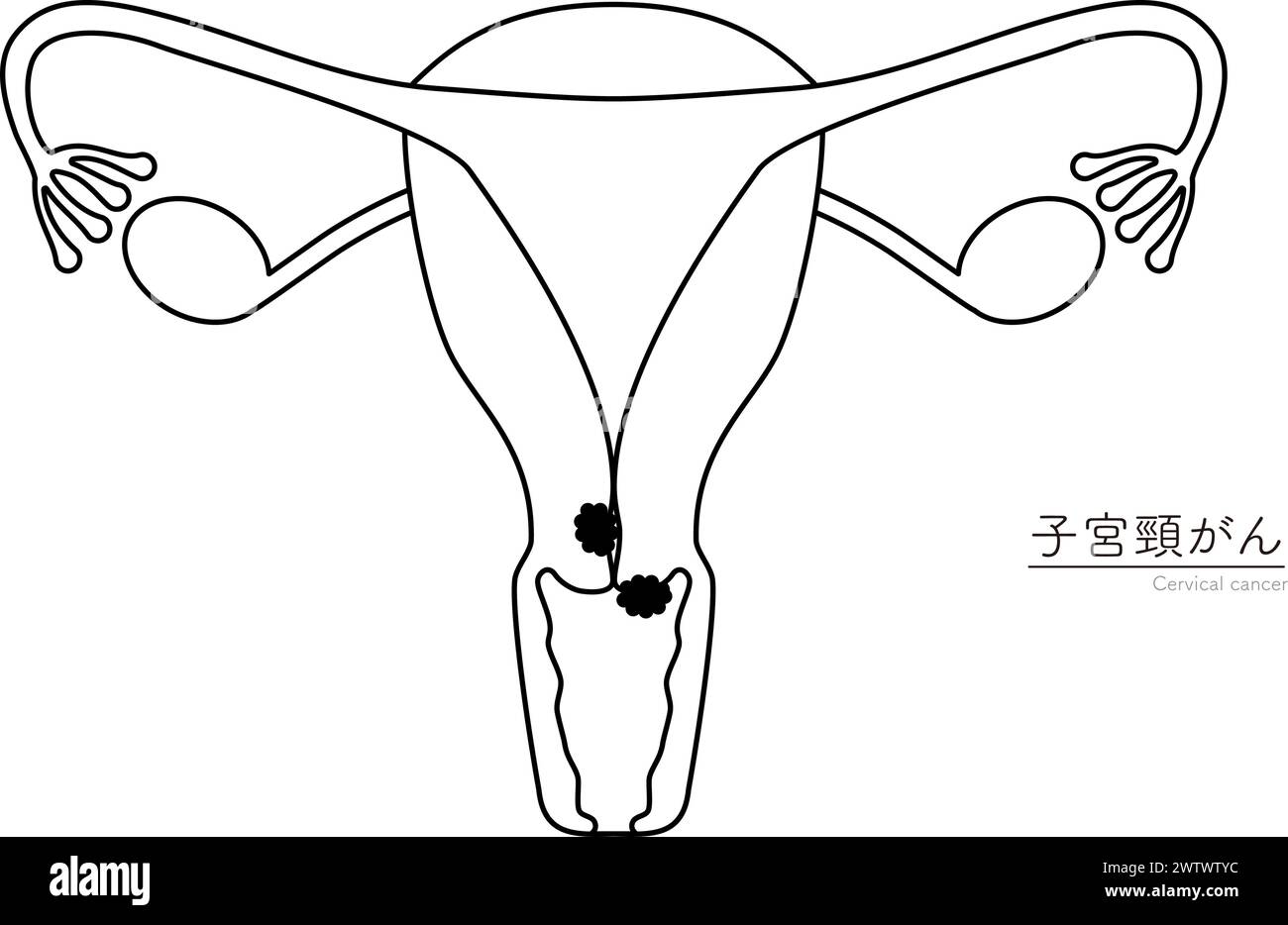 Diagrammatic illustration of cervical cancer, anatomy of the uterus and ...
