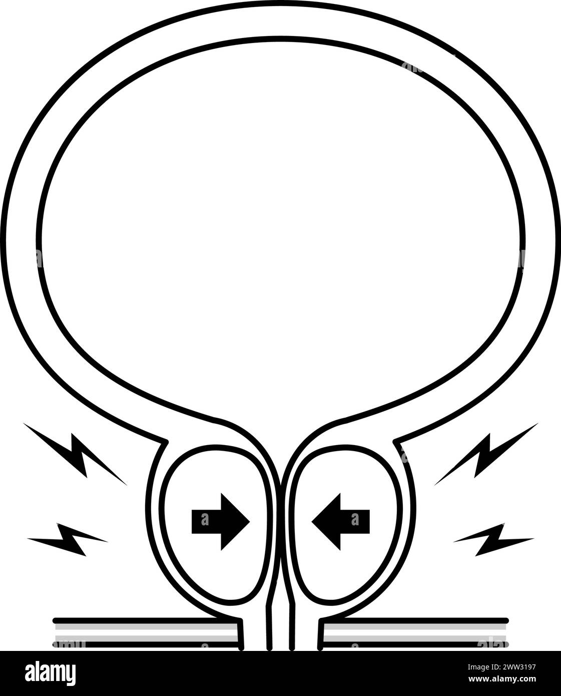 Medical Illustration Of Benign Prostatic Hyperplasia Enlarged Prostate