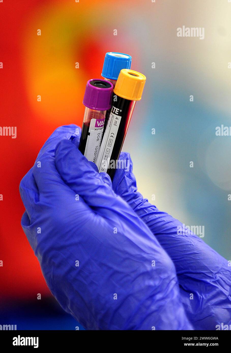 File photo dated 07/04/11 of blood samples being held. Scientists say they are close to developing a blood test that could identify millions of people who spread tuberculosis unknowingly. Researchers from the University of Southampton have discovered a group of biological markers that are found in high levels among infectious patients. Issue date: Friday March 22, 2024. Stock Photo