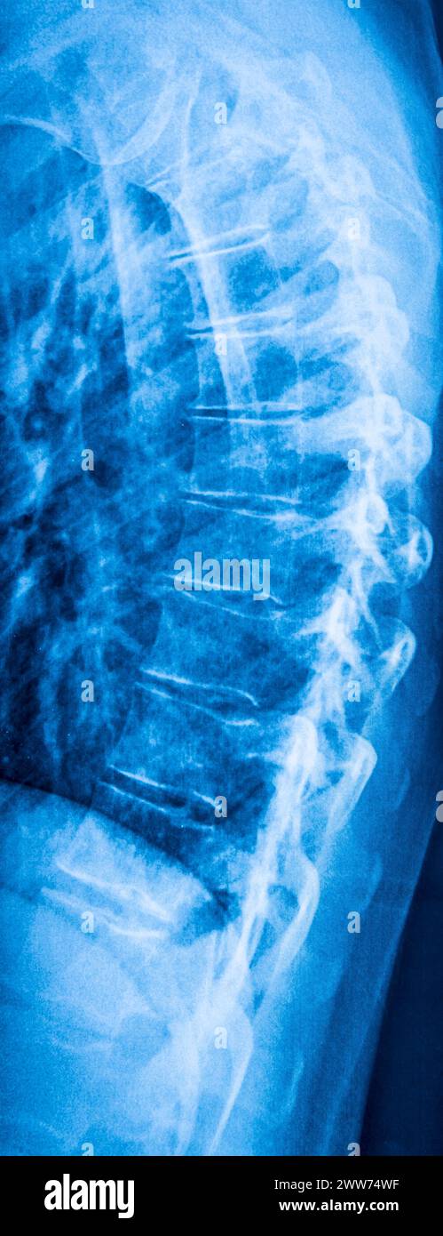 X-ray of a spine affected by kyphosis, side view. Stock Photo