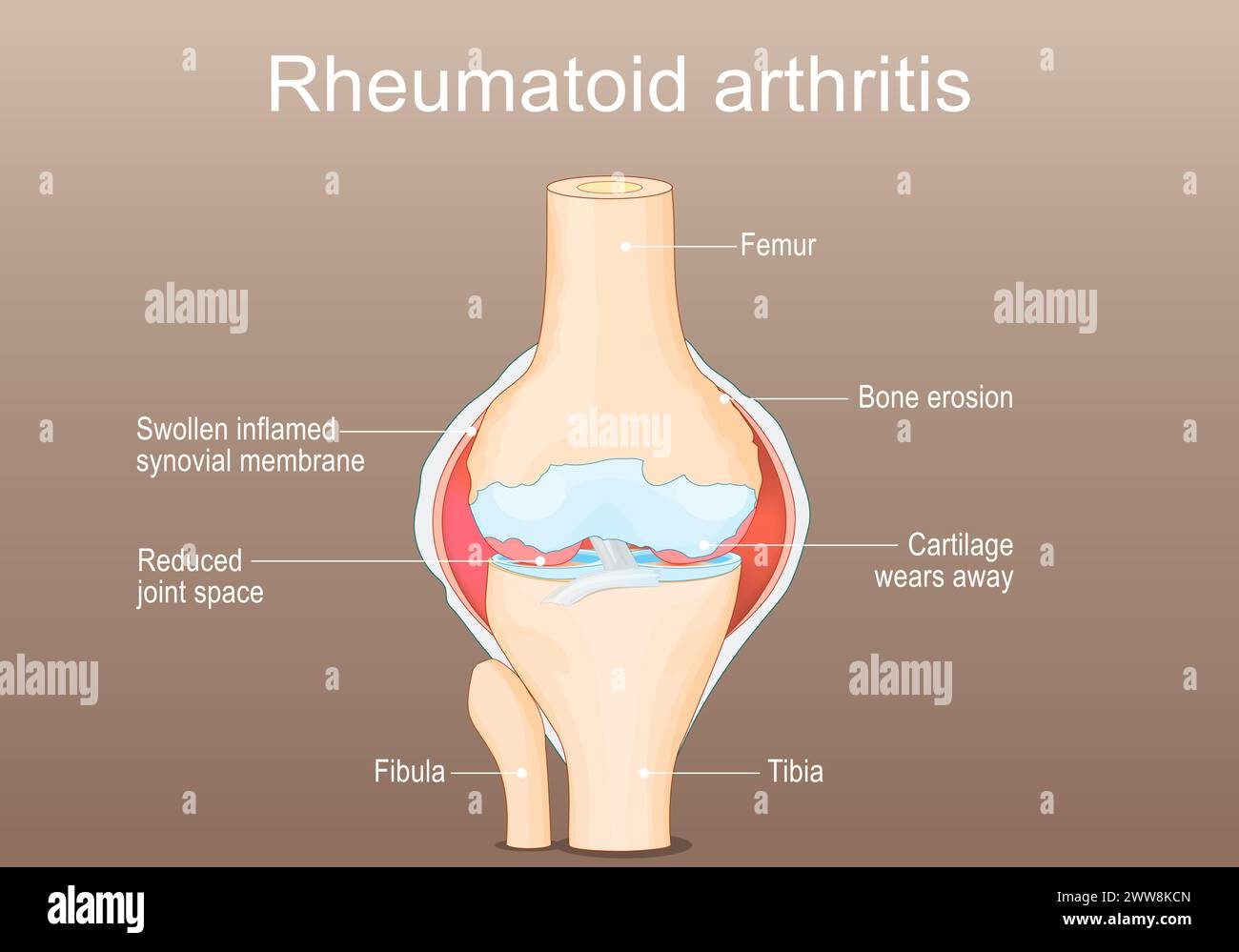 Rheumatoid Arthritis RA. Inflammatory type of arthritis that affects of knee. Auto immune disease. The immune system mistakenly attacks healthy joint Stock Vector