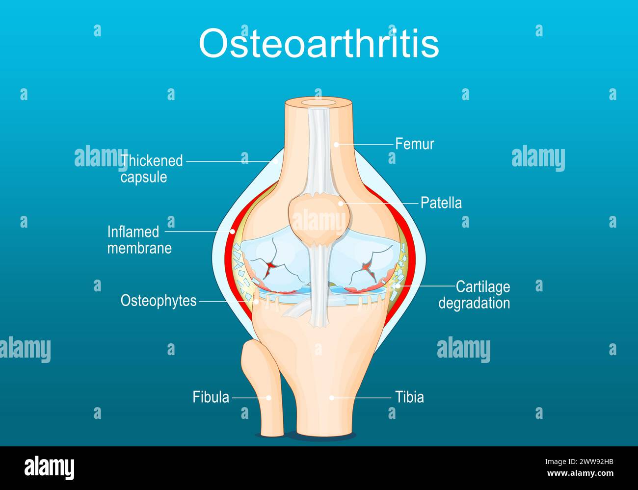 Osteoarthritis. Arthritis of a knee joint. Pain within a knee. Degenerative joint disease. Isometric Flat vector illustration Stock Vector
