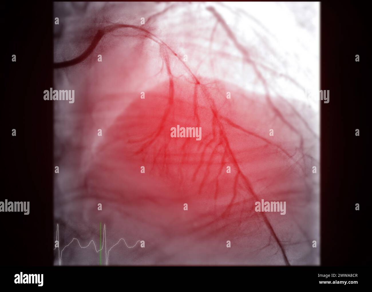 Cardiac Catheterization is a medical procedure used to examine the heart's blood vessels. Stock Photo