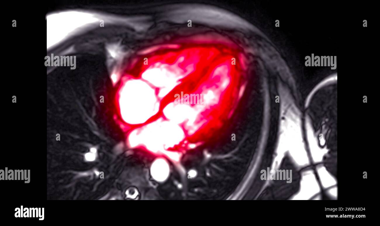 Cardiac MRI evaluates heart health, providing detailed images for diagnosing cardiovascular conditions and planning treatment Stock Photo