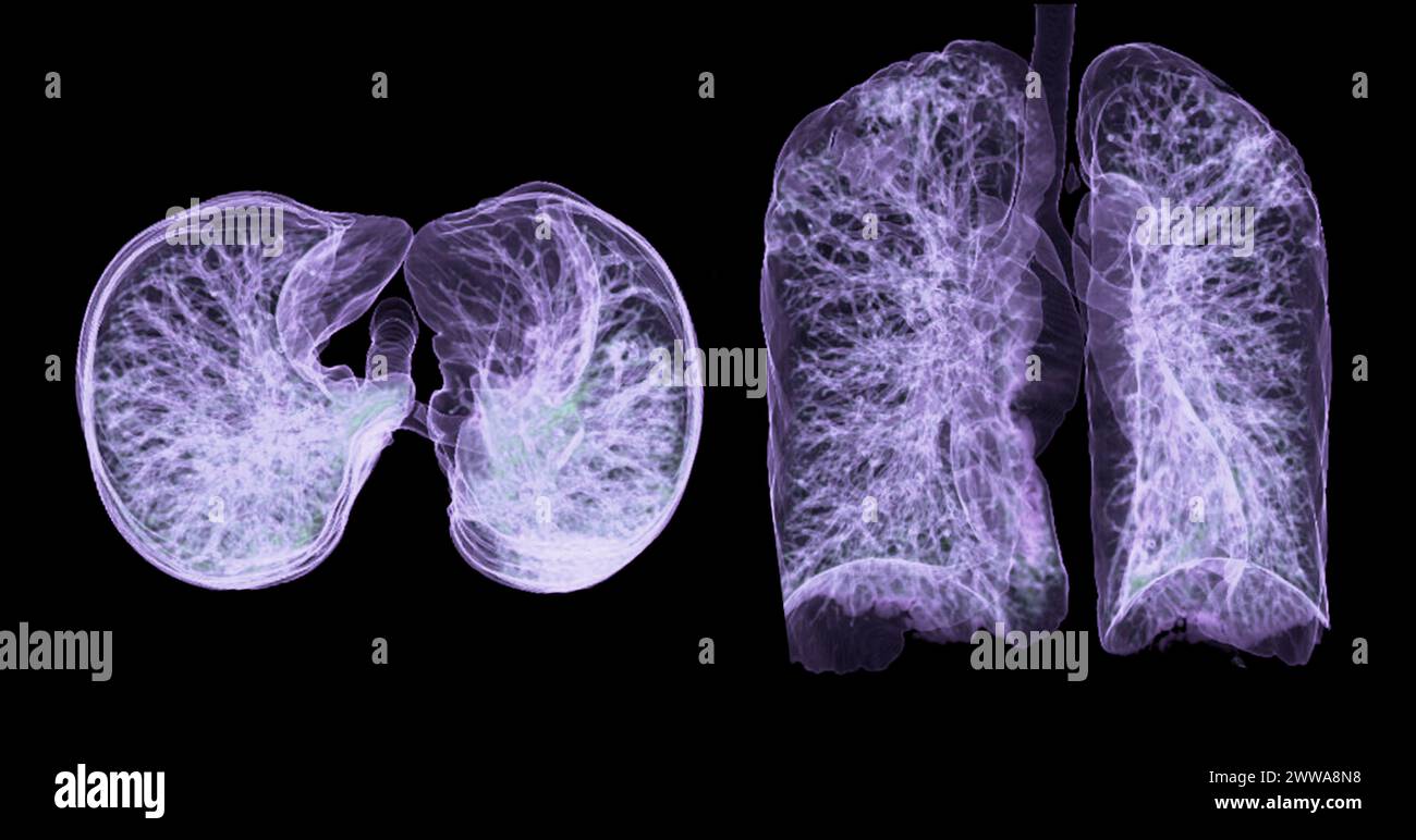 A CT chest 3D scan displaying a lesion at the right upper lobe offers a detailed visualization, aiding in precise identification and  treatment planni Stock Photo