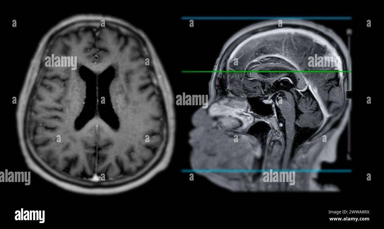MRI brain scan sagittal plane for detect Brain diseases sush as stroke ...