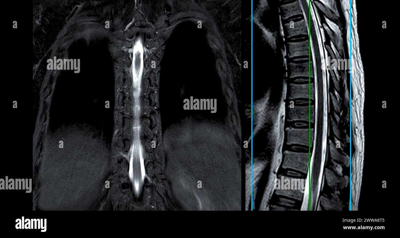 MRI TL spine or Thoracosacral spine Axial and sagittal T2 technique
