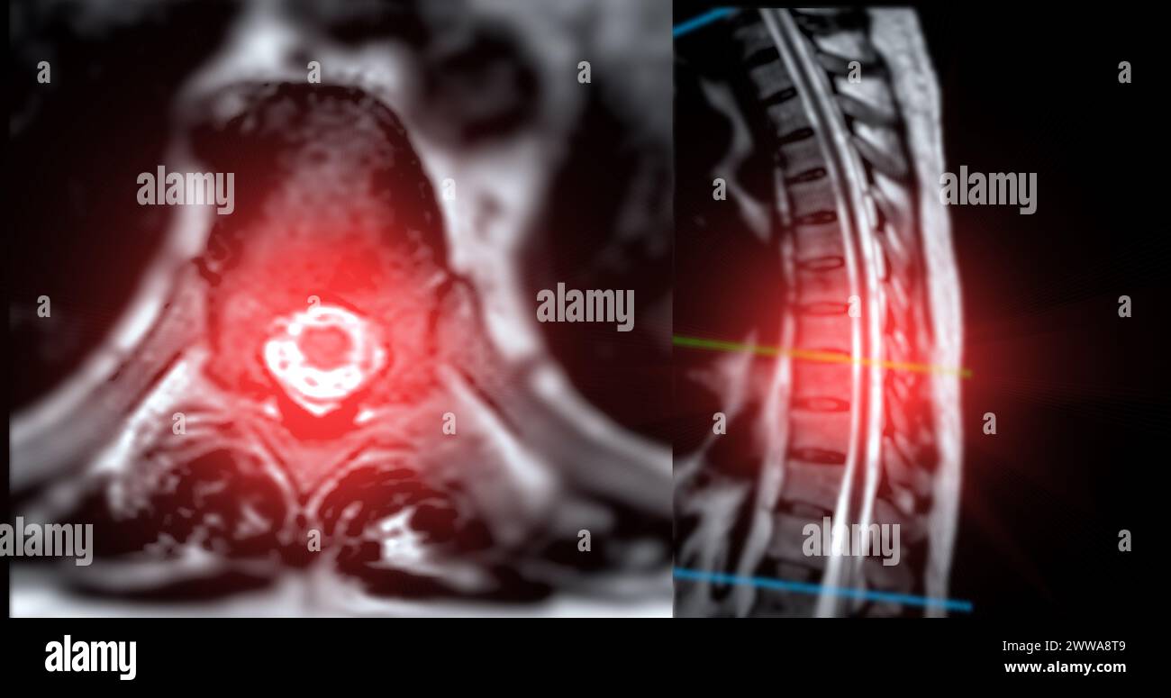 MRI T-L spine or Thoracosacral spine Axial and sagittal T2 technique with reference line  for diagnosis spinal cord compression. Stock Photo