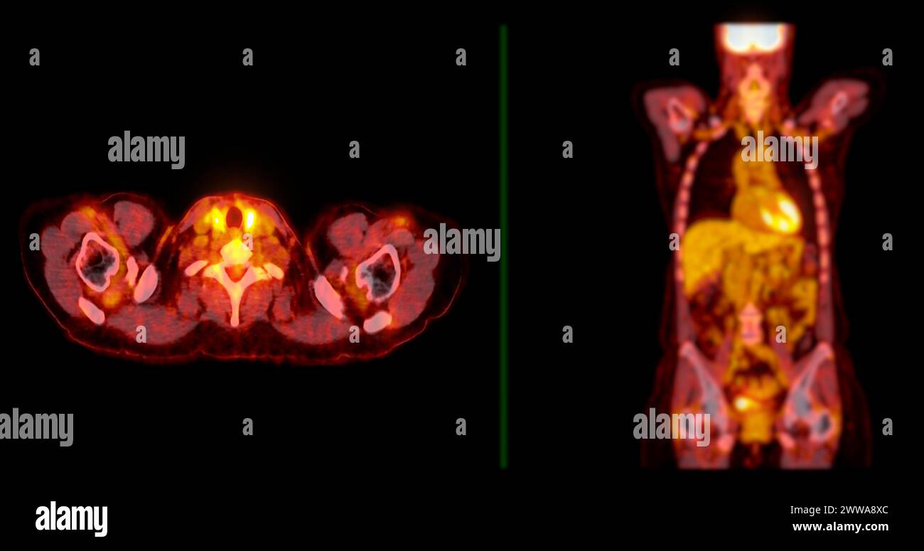A PET-CT scan image is a diagnostic visualization combining Positron ...