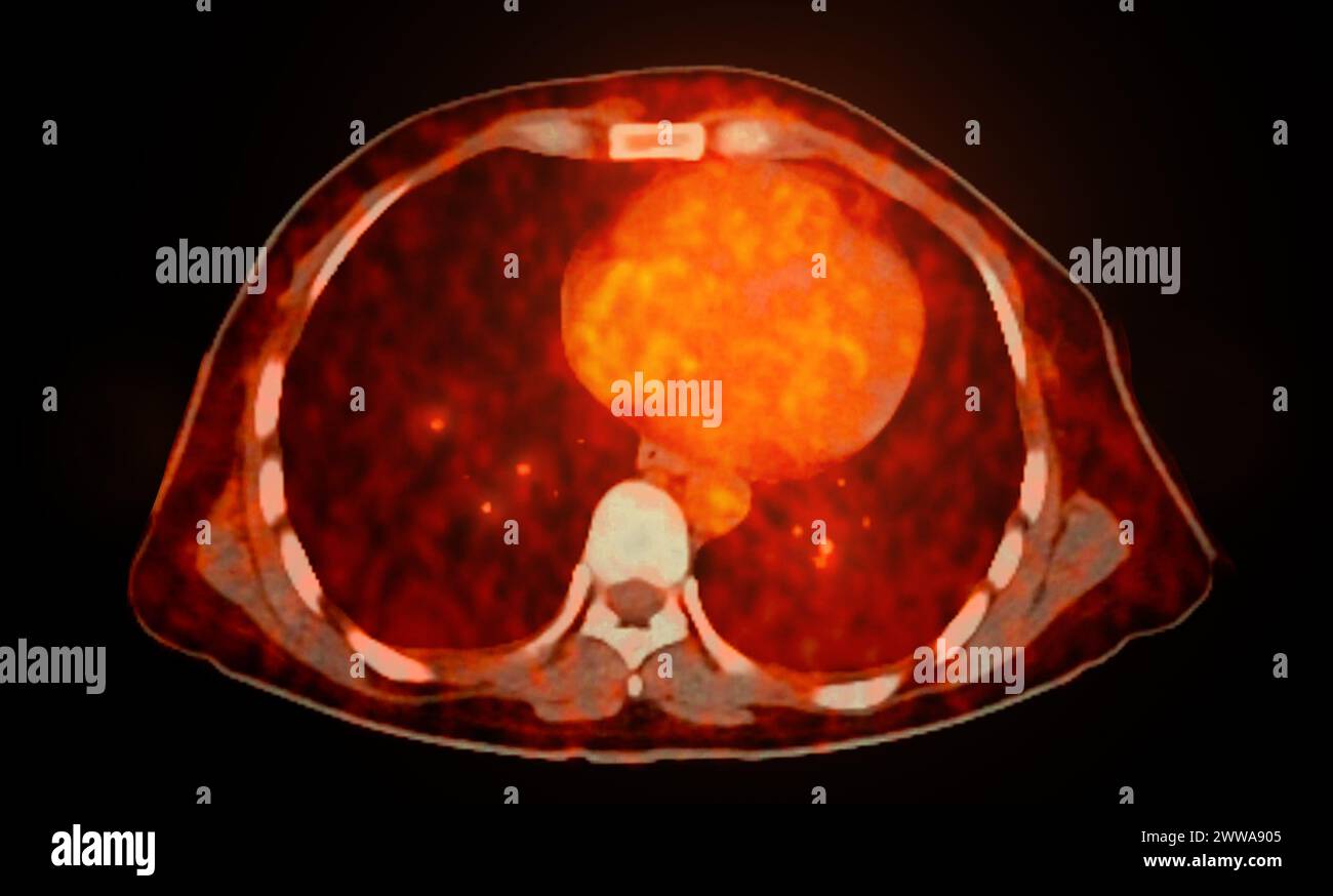 A PET-CT scan image is a diagnostic visualization combining Positron ...