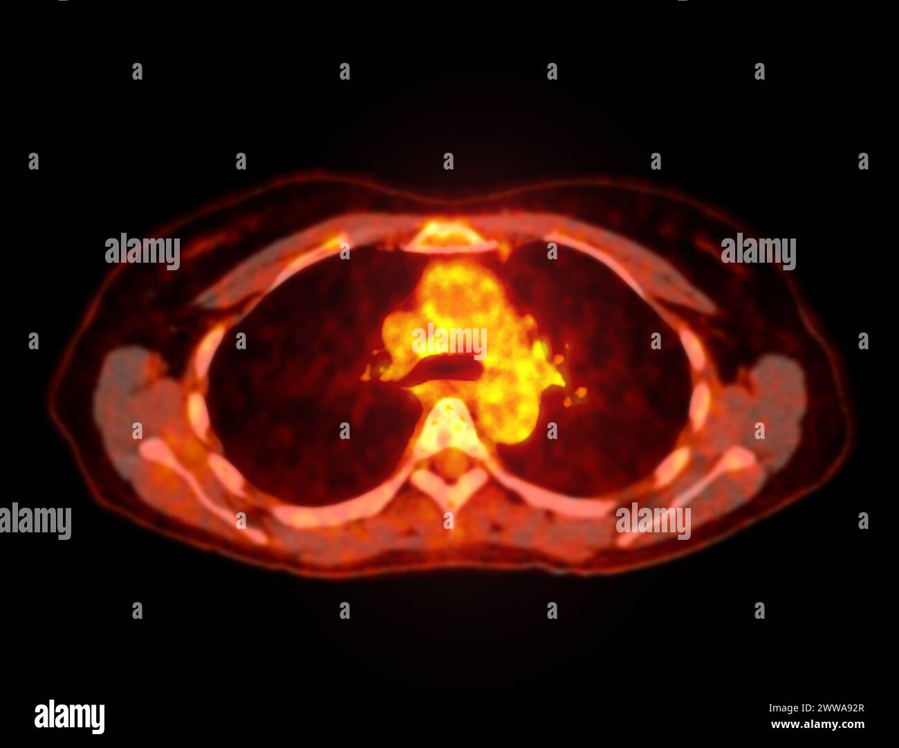 A PET-CT scan image is a diagnostic visualization combining Positron Emission Tomography (PET) and Computed Tomography (CT) for Helps in finding cance Stock Photo