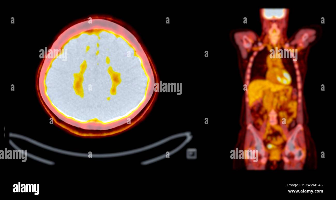 A PET-CT scan image is a diagnostic visualization combining Positron ...