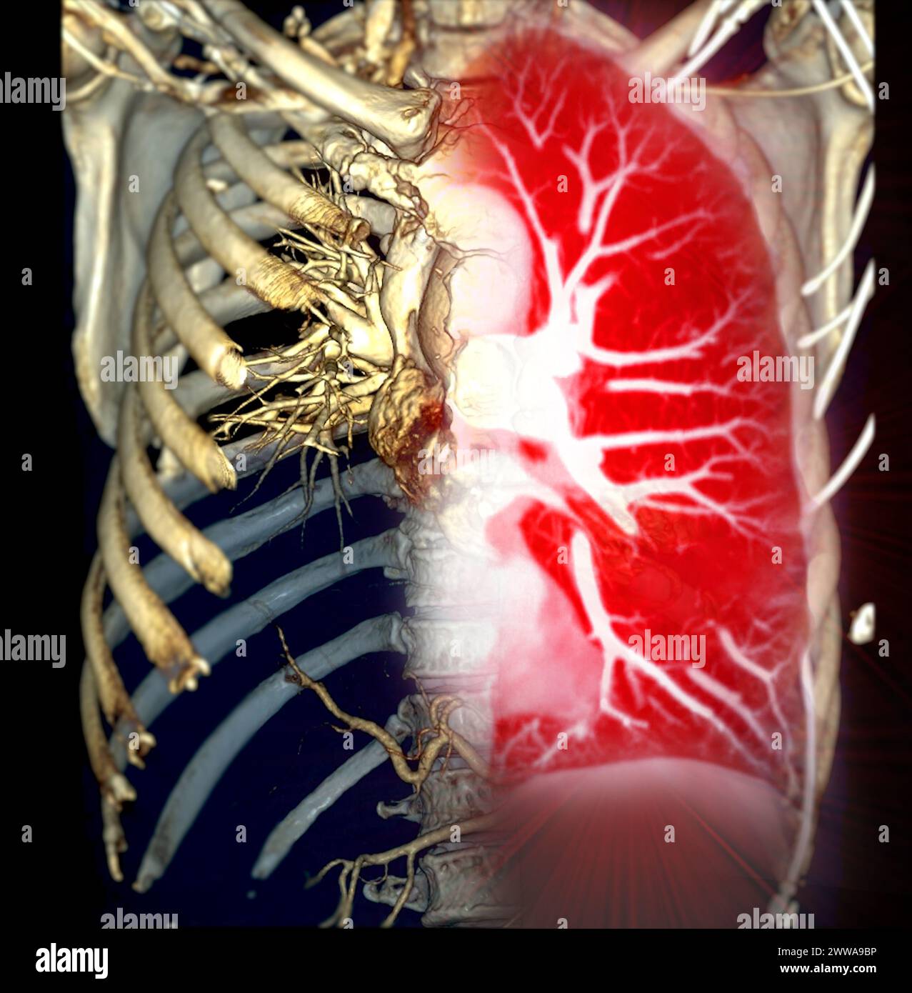 CTA thoracic aorta 3D rendering offers detailed visualization, providing clear insights into aortic anatomy, pathology, and surrounding structures for Stock Photo