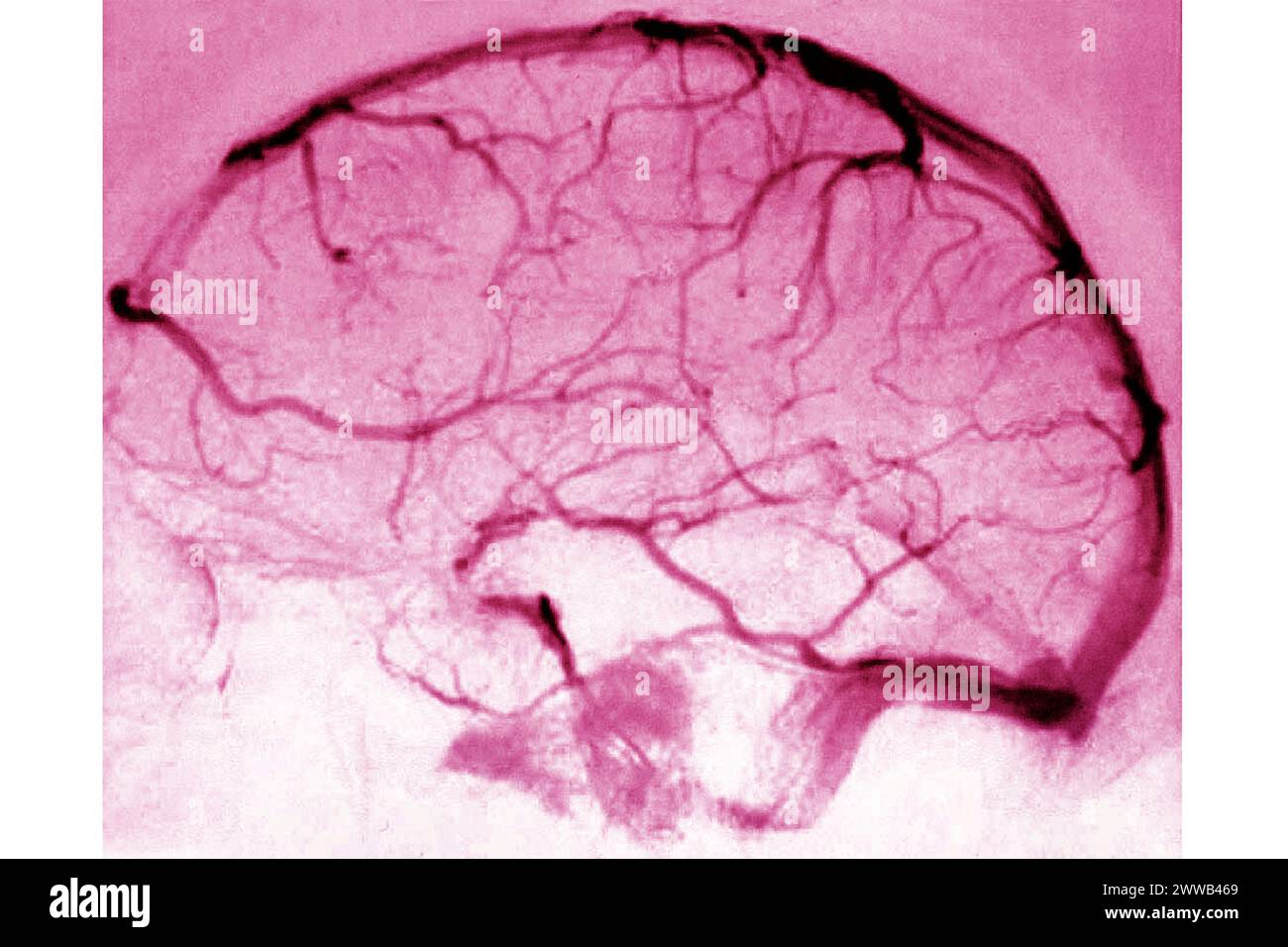 Cerebral angiography (x-ray examination visualizing the arteries and ...