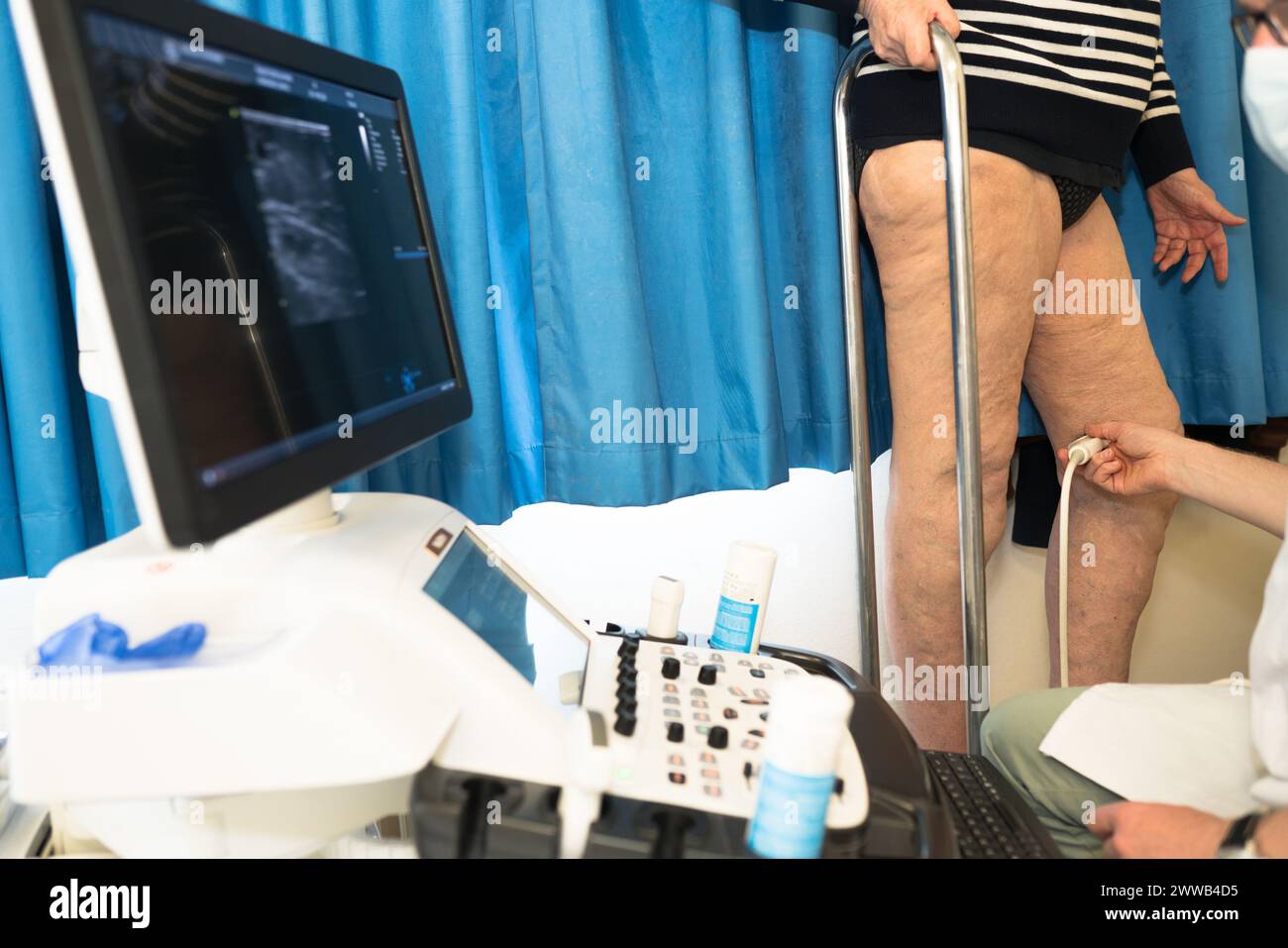 Treatment of varicose veins by foam echosclerotherapy, injection into a