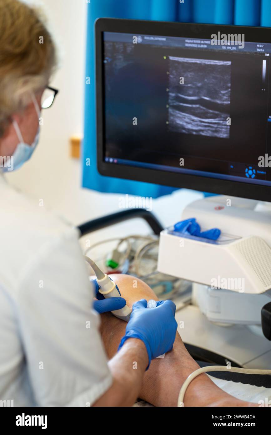 Treatment of varicose veins by foam echosclerotherapy, injection into a