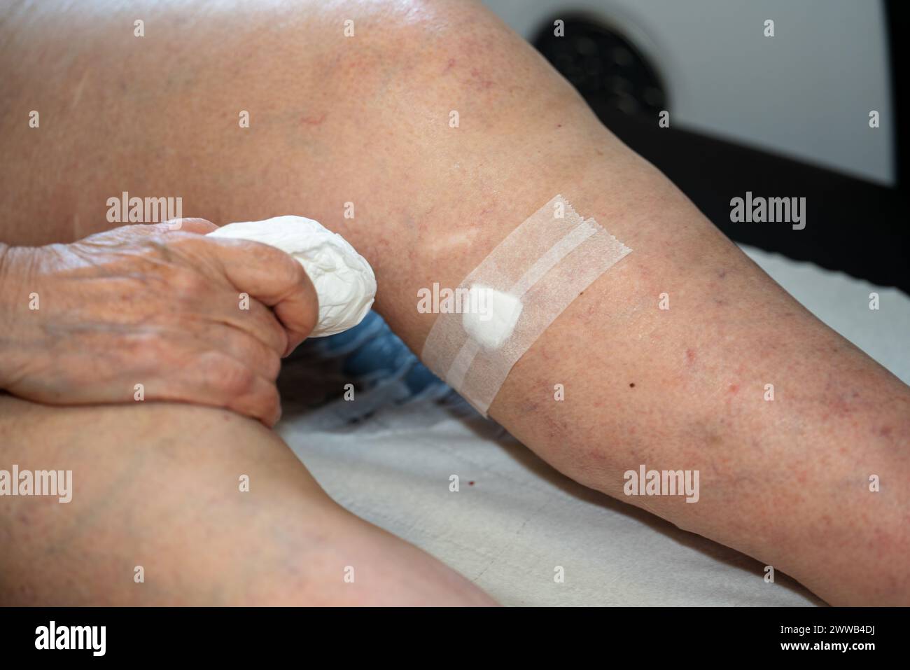 Treatment of varicose veins by foam echosclerotherapy, injection into a