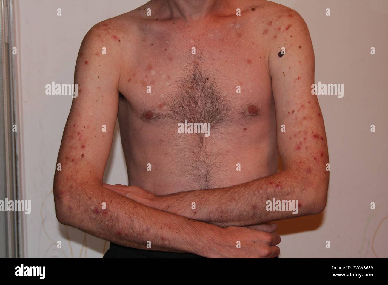 Compulsive Scatching Obsessive disorders hi-res stock photography and images - Alamy