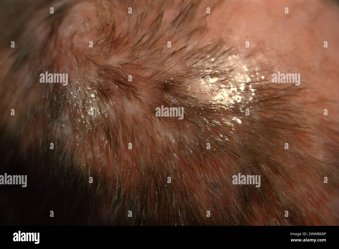 The favus on this patient’s scalp is due to the fungus T. schoenleinii. Stock Photo