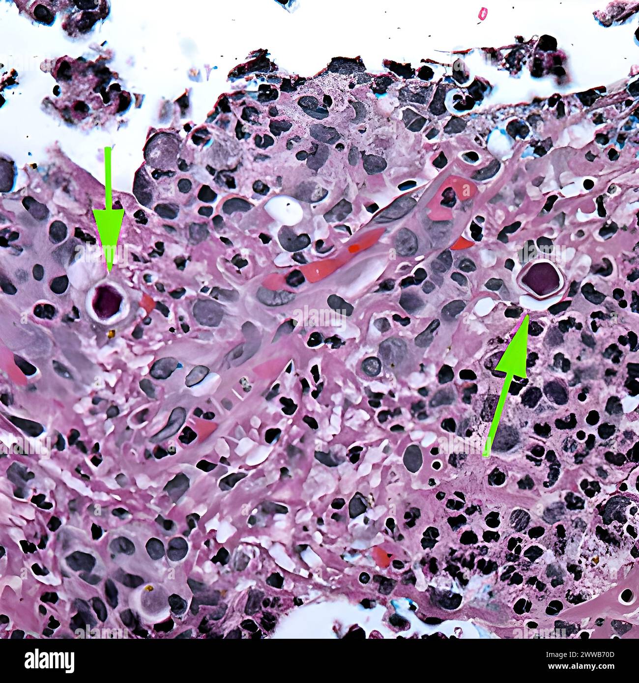 Acanthamoeba eye hi res stock photography and images alamy