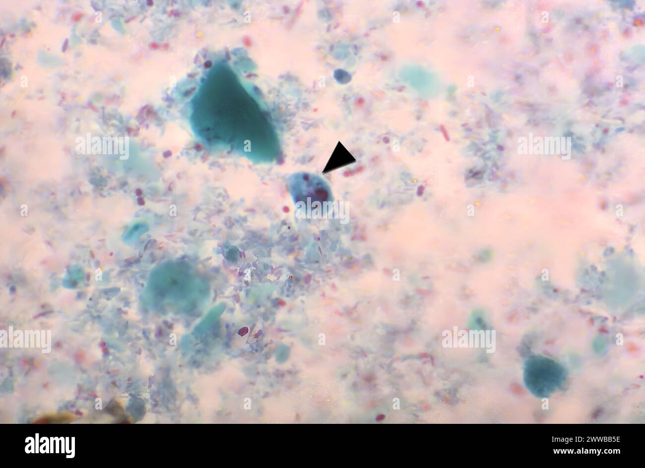 This photomicrograph of a trichrome-stained specimen revealed the presence of a binucleate cyst of Entamoeba hartmanni (arrow). The cysts of E. Stock Photo