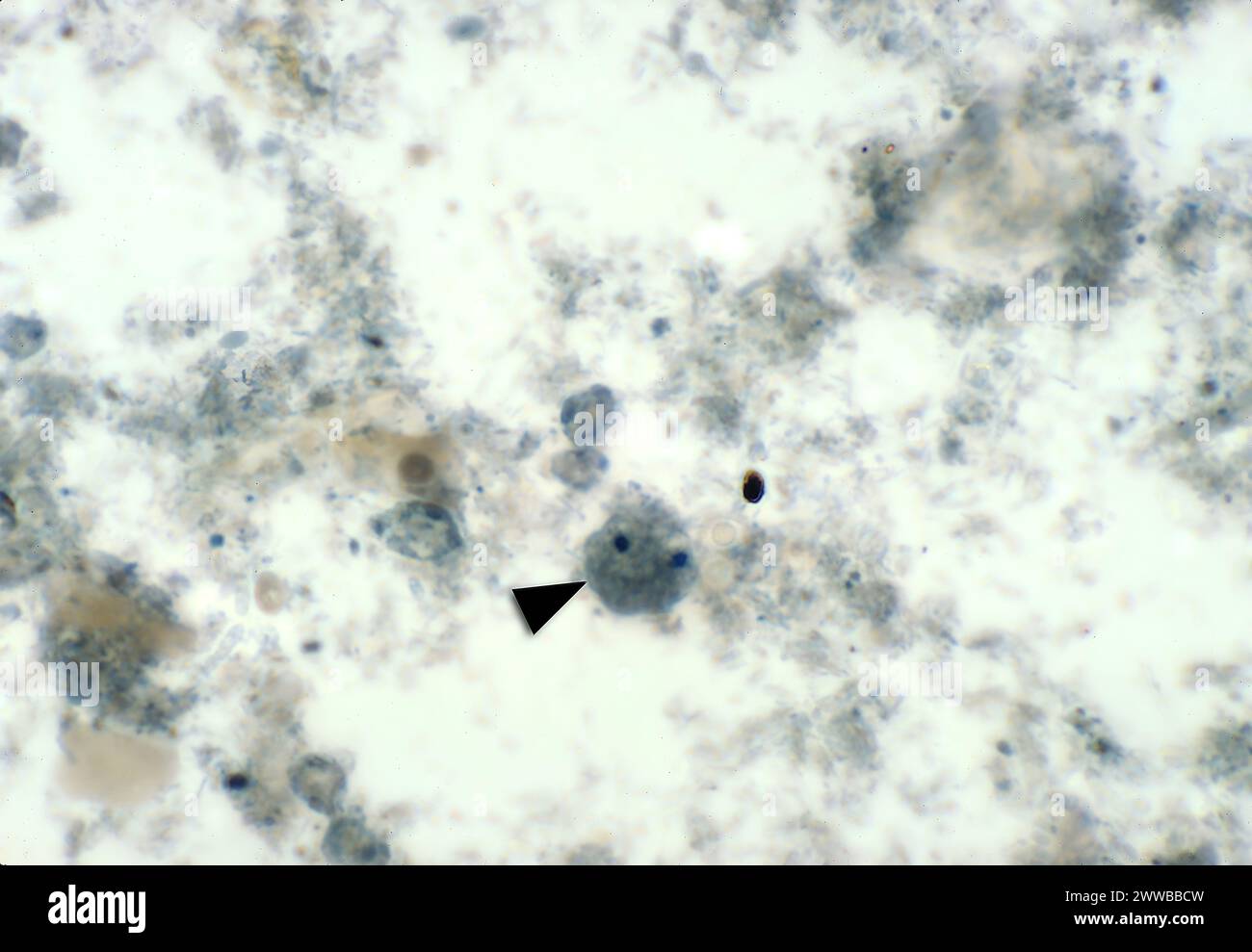 This photomicrograph revealed a good example of a binucleate parasitic trophozoite, Dientamoeba fragilis, stained with iron and hematoxylin. Stock Photo