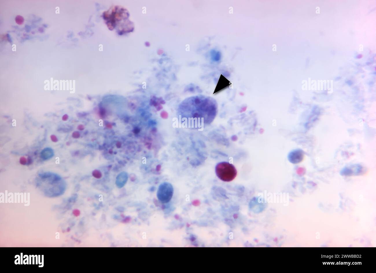 This photomicrograph revealed the presence of a binucleate parasitic trophozoite of Dientamoeba fragilis, stained with trichrome. Stock Photo