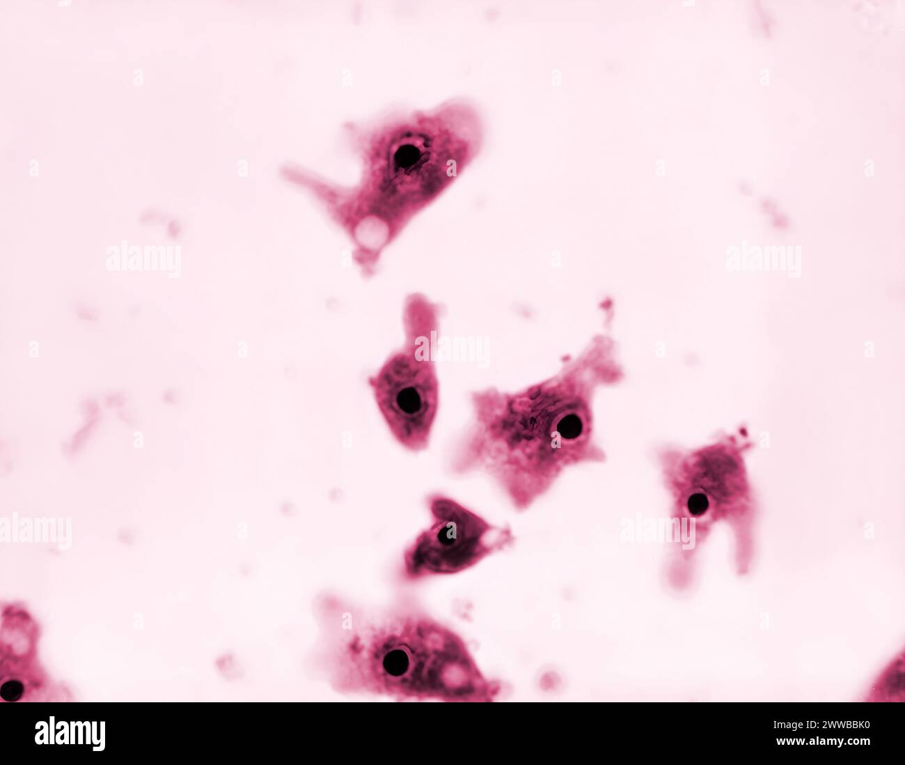 Under a magnification of 1750X, this photomicrograph of a nasal swab specimen, revealed the presence of numerous, trophozoite-staged amoebae. Stock Photo