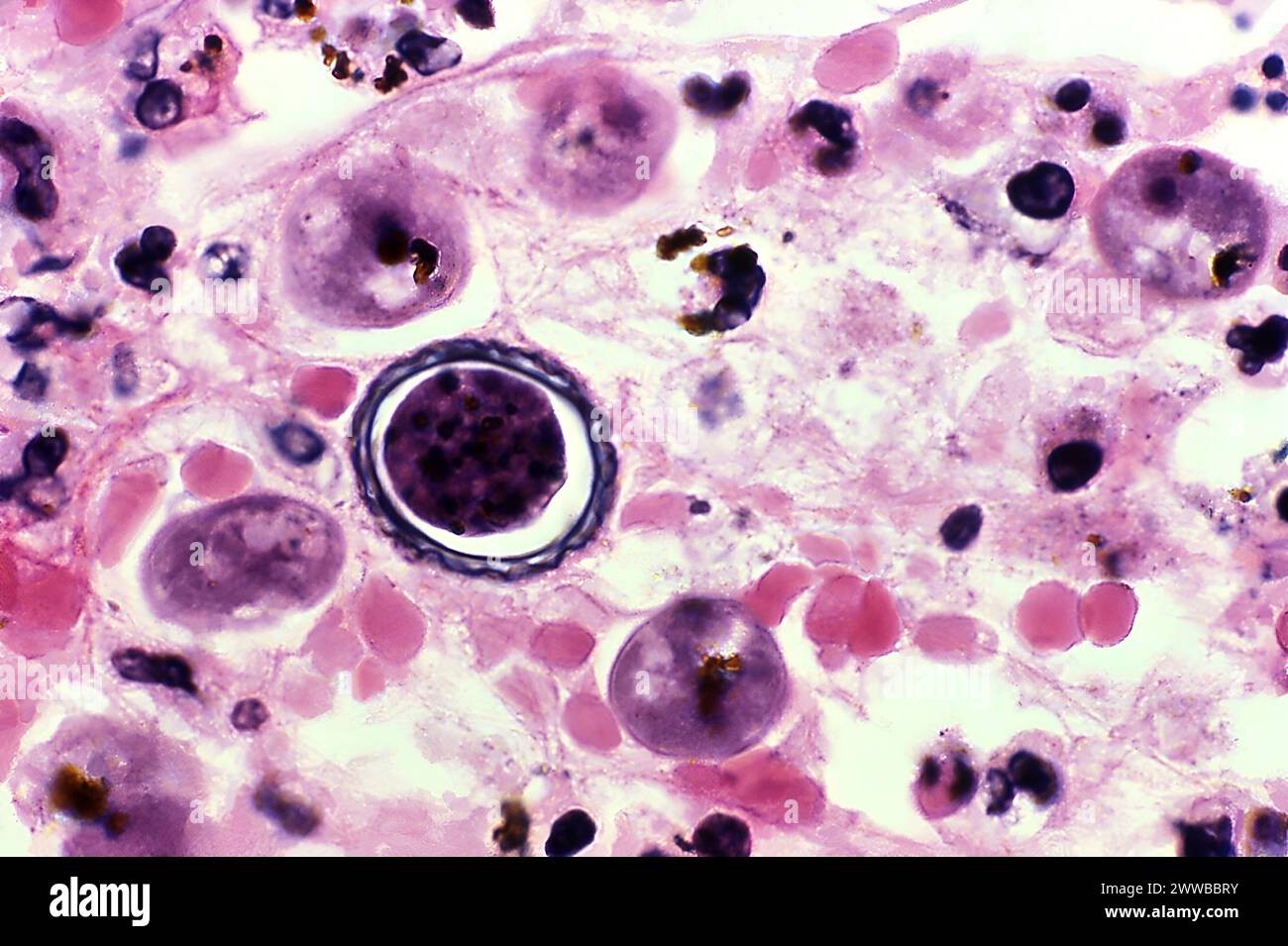 This photomicrograph depicted a view of brain tissue in which an Acanthamoeba sp. cyst. CDC/DPDx George Healy, Ph.D. 1977. Stock Photo