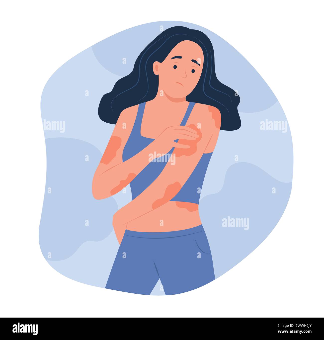 Woman with Eczema on Body for Dermatology Concept Illustration Stock Vector