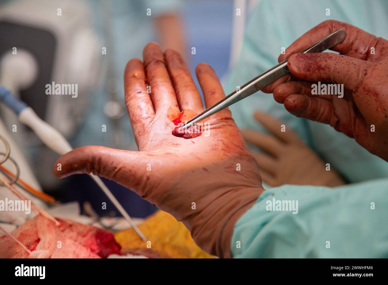 The doctor shows the cancerous tumor that he removed during the ...