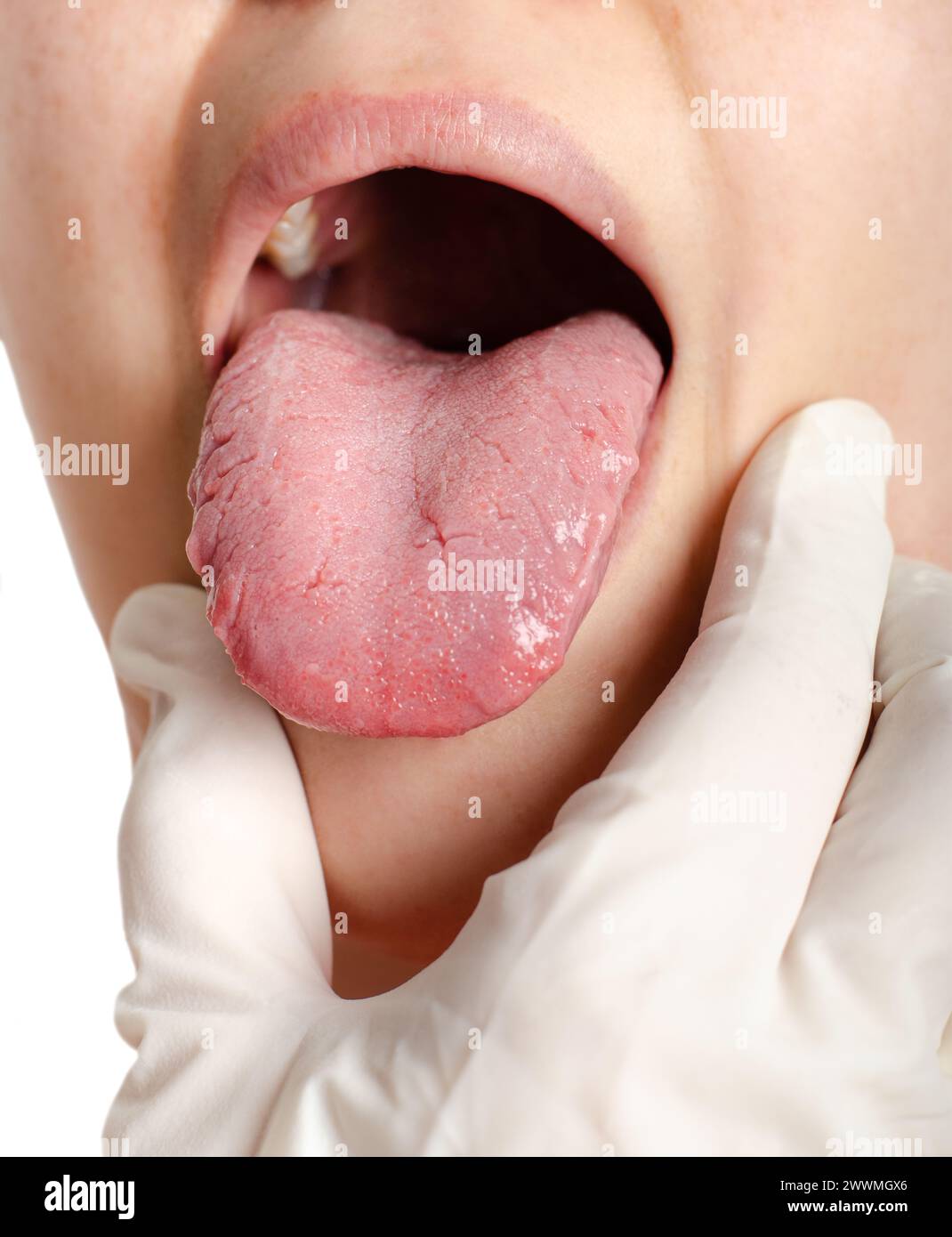 Woman with geographical tongue. Migratory glossitis. Stock Photo