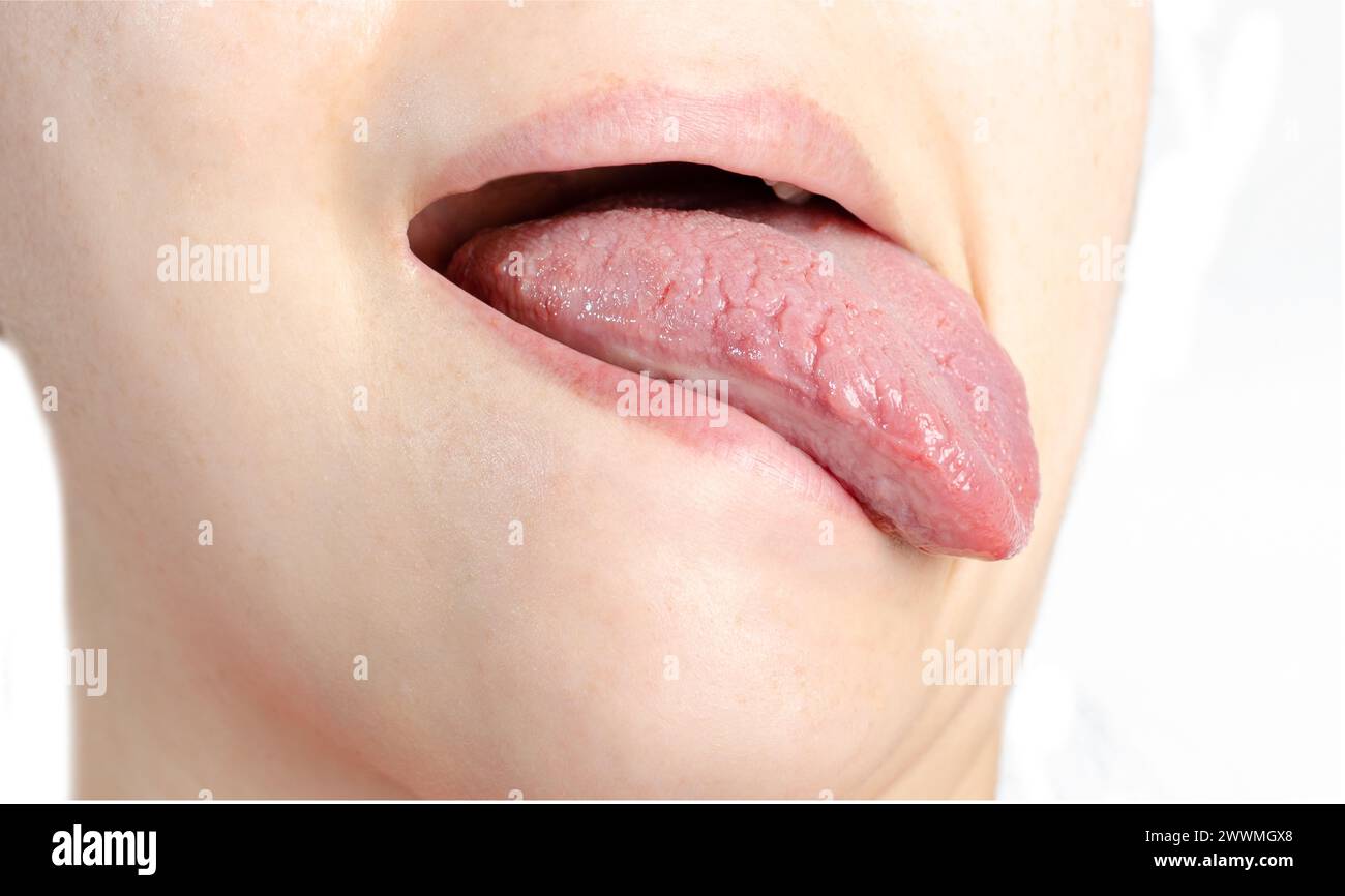 Woman with geographical tongue. Migratory glossitis. Stock Photo