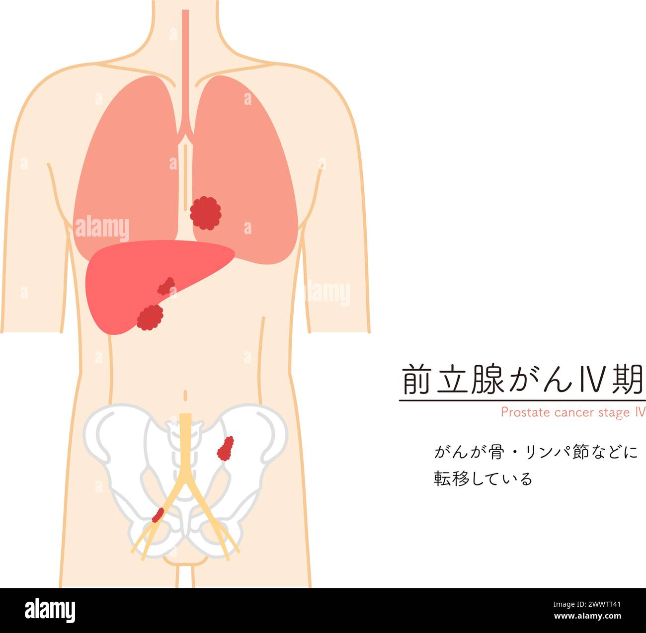 Prostrate Node Medical Illustration of Prostate, Stage 4 Prostate Cancer - Translation ...
