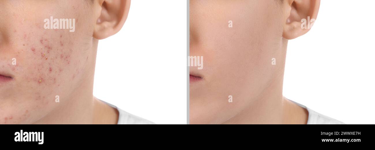Acne problem. Young man before and after treatment on white background ...