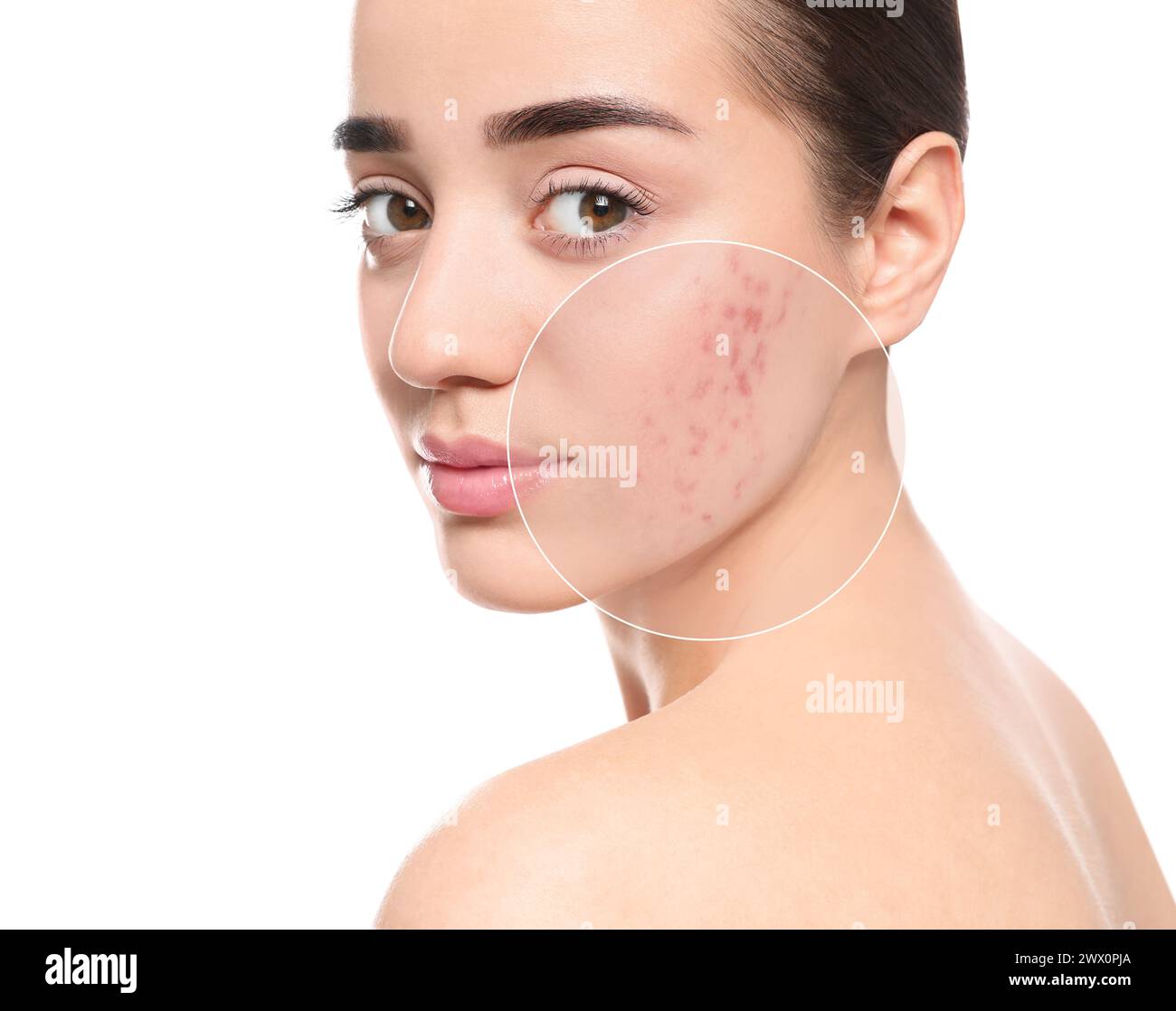 Woman with acne on her face on white background. Zoomed area showing ...