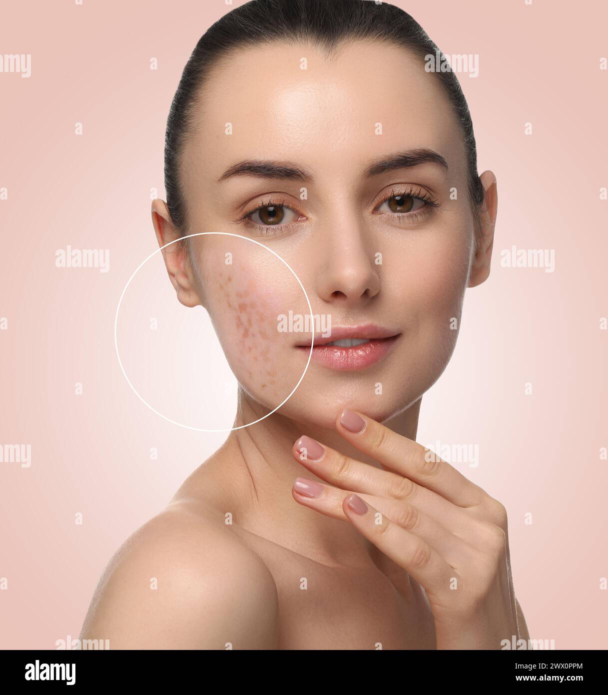 Woman with acne on her face on beige gradient background. Zoomed area ...
