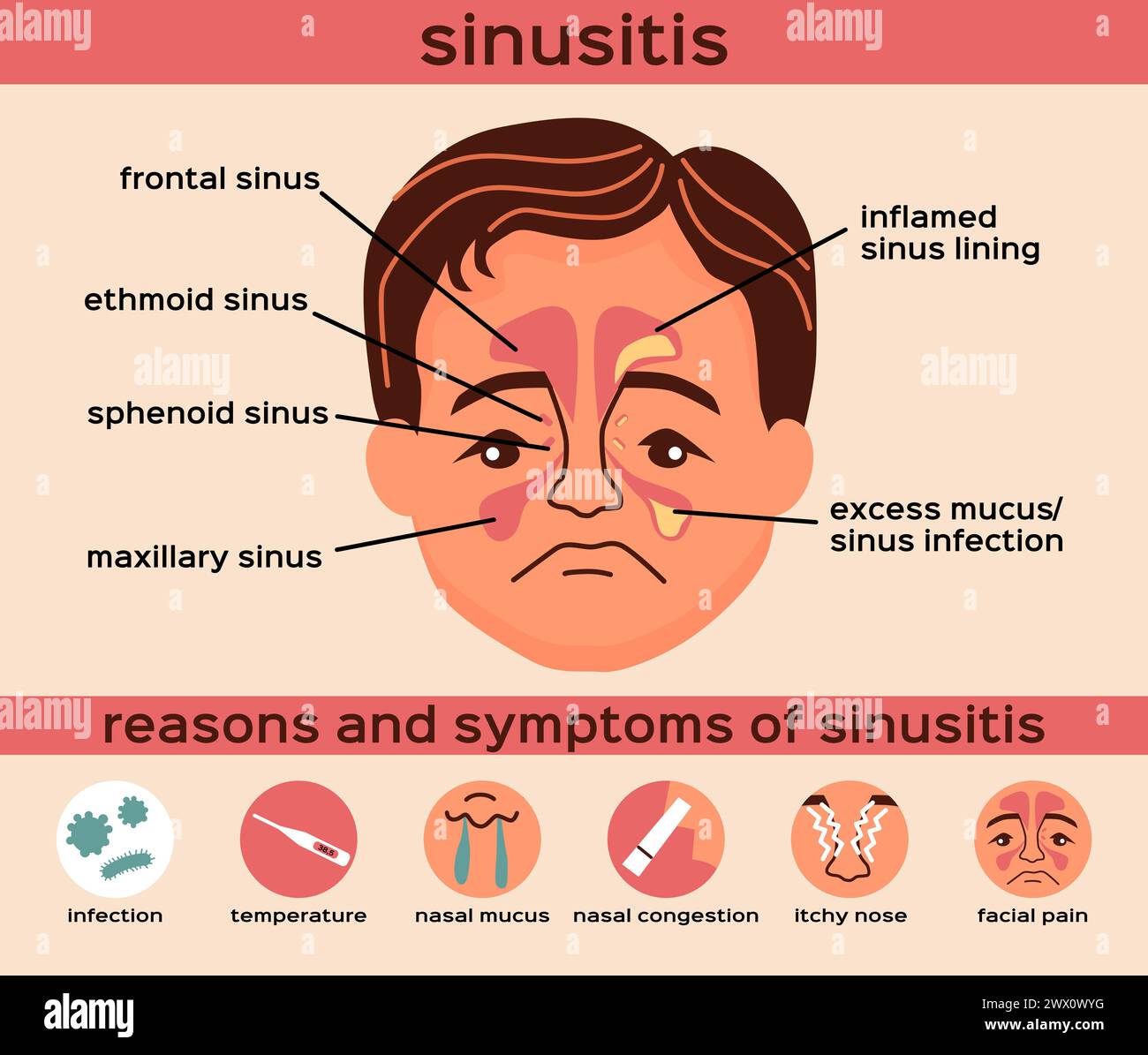 Nasal disease flat infographics layout with reasons and symptoms of sinusitis vector illustration Stock Vector