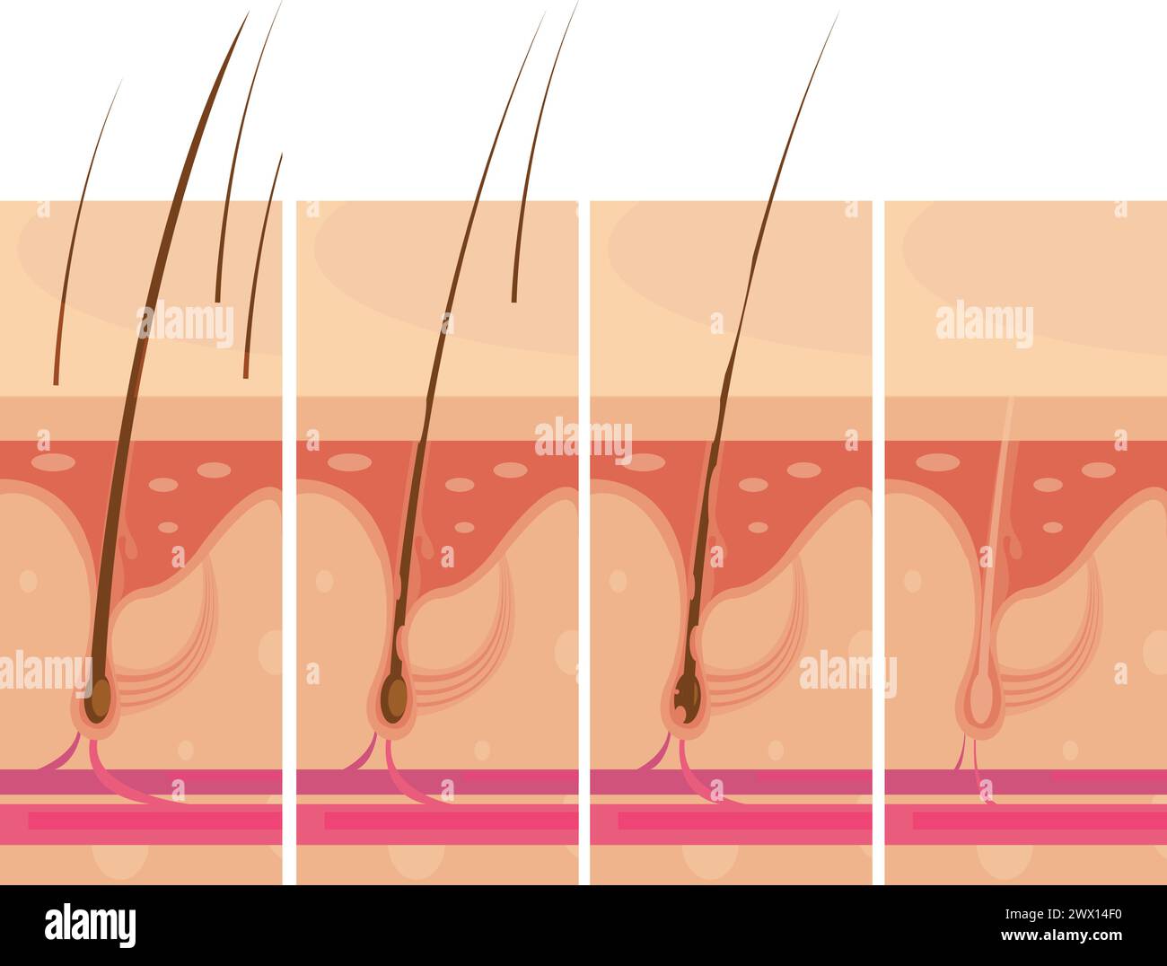 Hair loss storyboard conceptual compositions set with profile macro view of balding scalp skin infographic images vector illustration Stock Vector