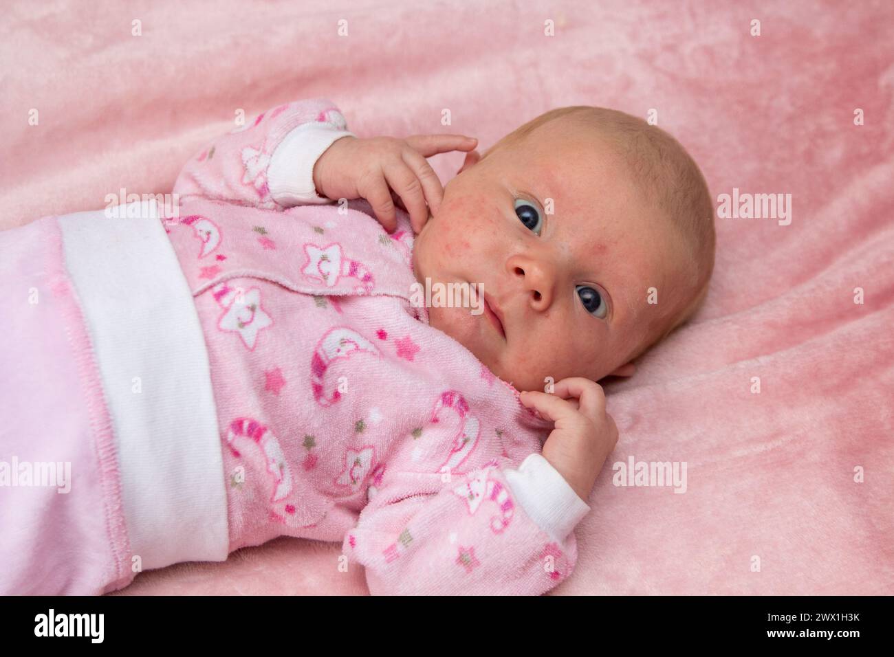 The baby lies on the bed and has allergies, rashes on the face of the newborn Stock Photo
