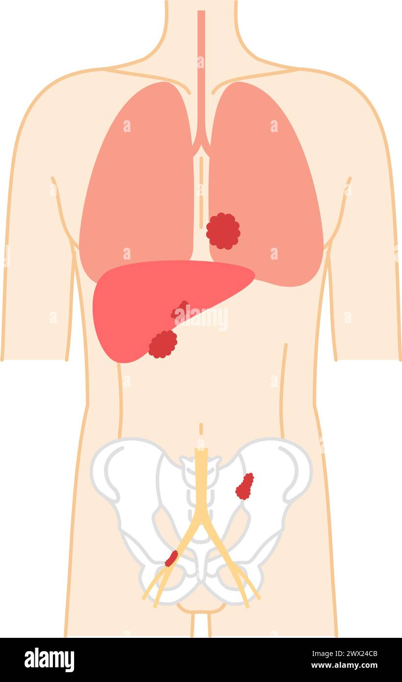 Prostate Stage 4